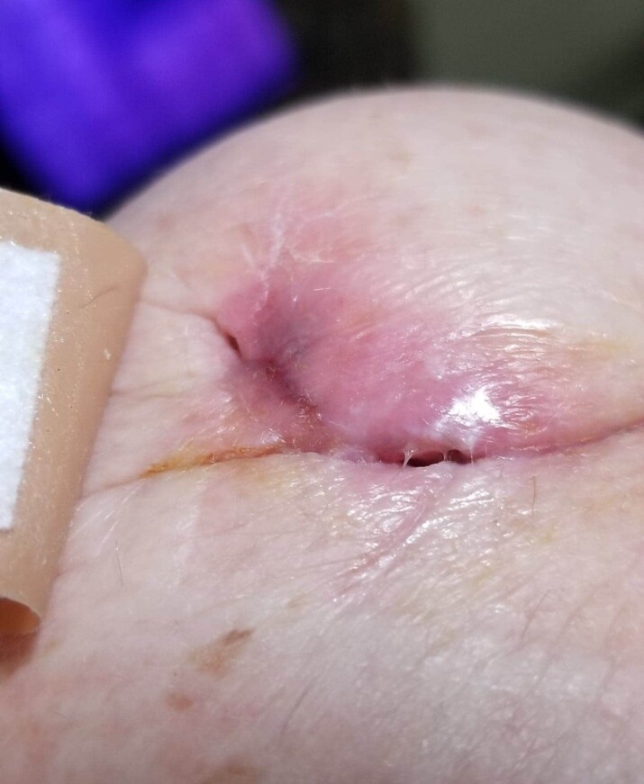 Close-up of a healing wound with adhesive tape on skin.